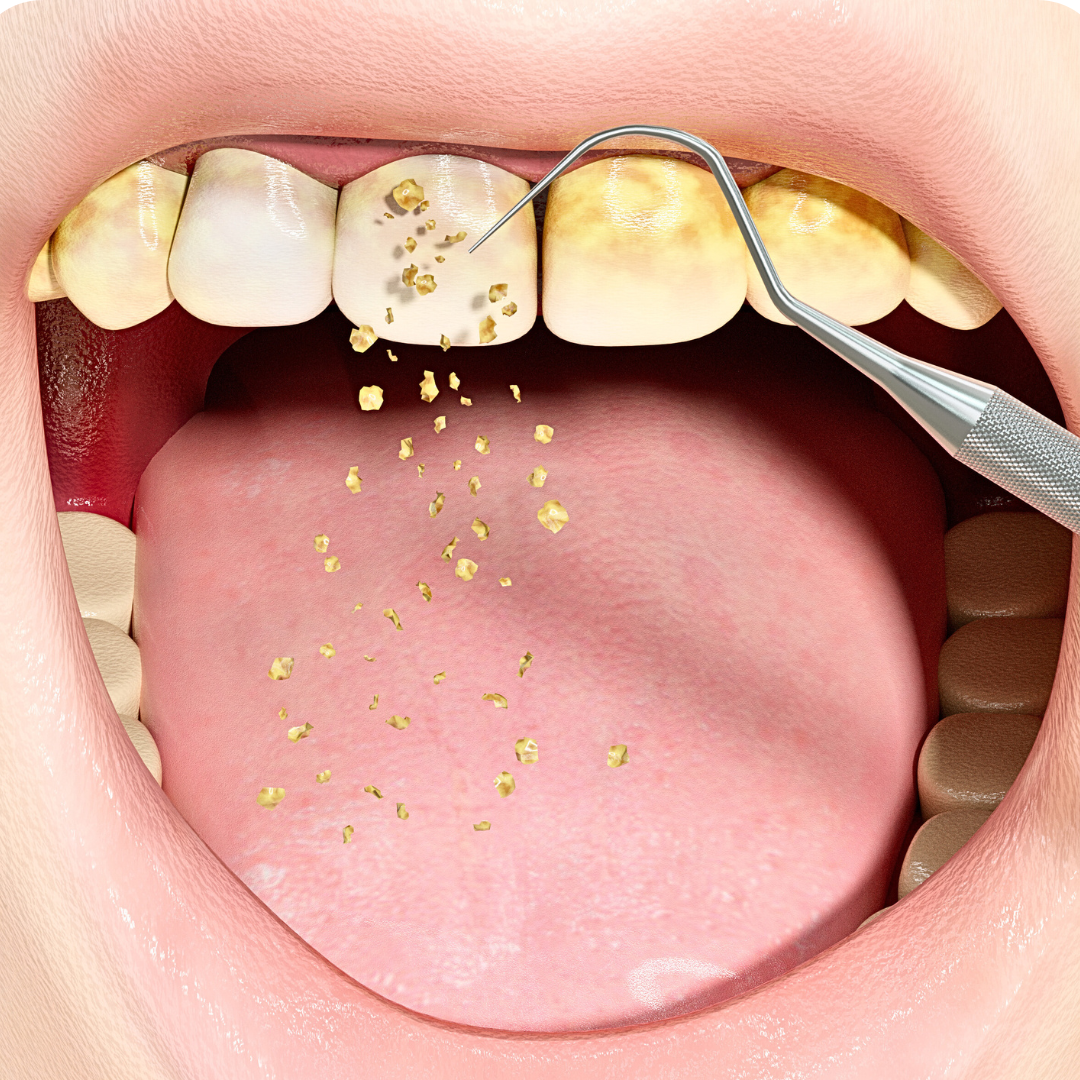 Ultrasonic Dental Cleaner For Dental Hygiene? Worth It?