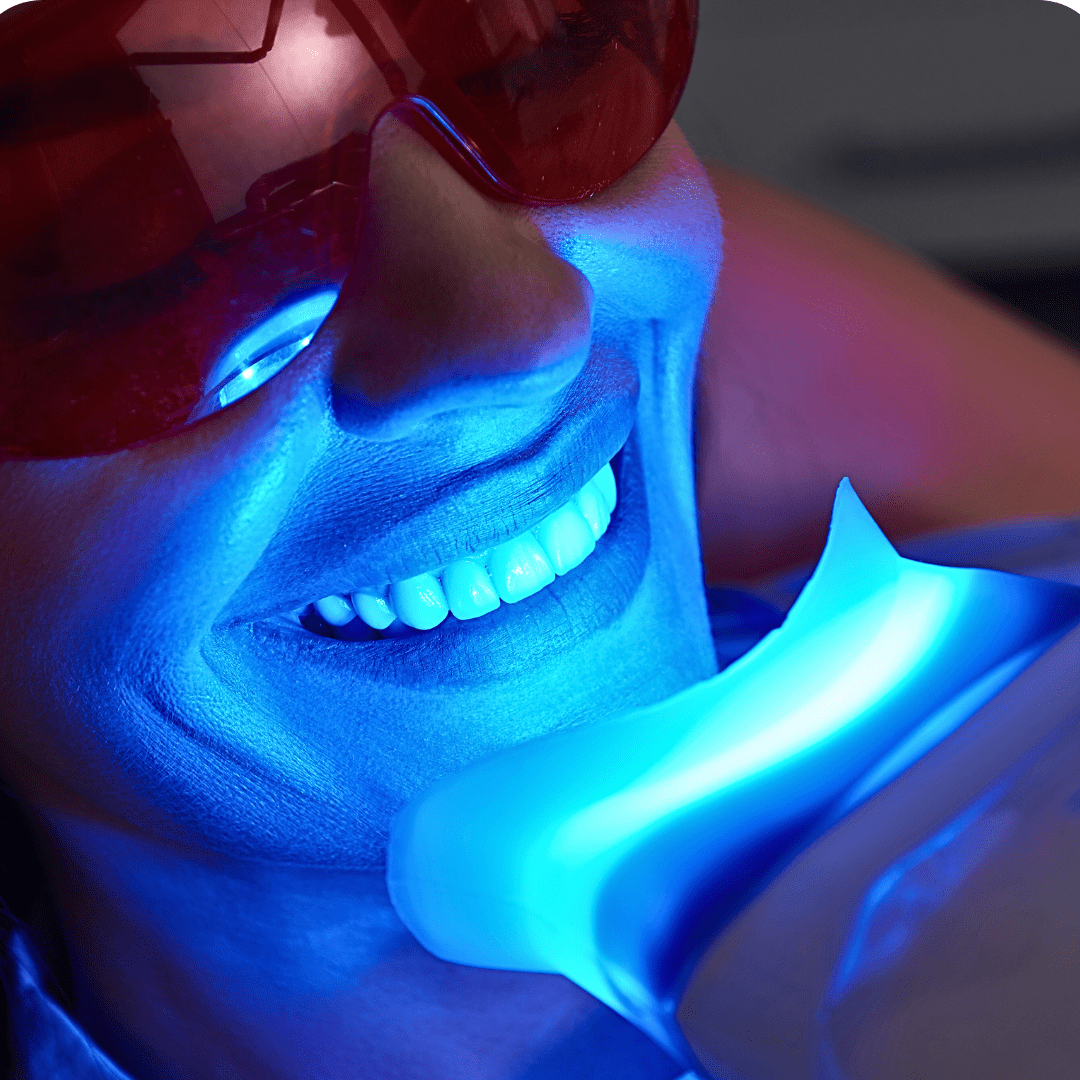 Teeth Whitening Gel: How to Whiten Safely at Home & What Really Works - Prime Oral Care